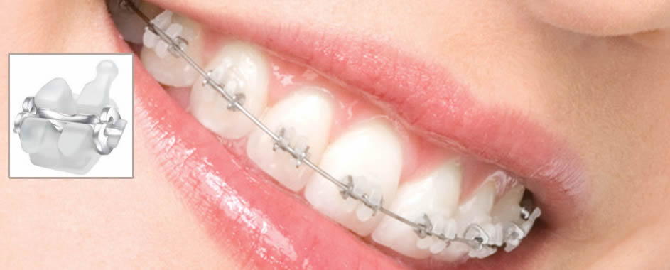 Brakets de Autoligado Cosmetico