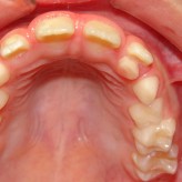 Erupción de dientes permanentes