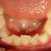 Apiñamiento dental