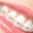 Brakets de Autoligado Cosmetico