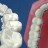 Brackets Linguales o Invisibles